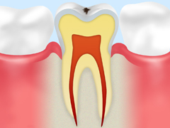 CＯ　初期の虫歯
