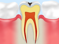 C1　エナメル質の虫歯